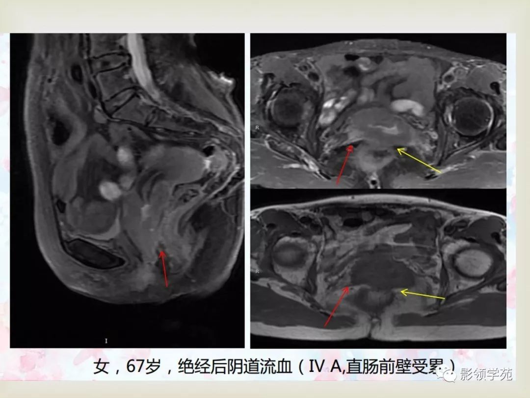 子宫卵巢病变的mri诊断