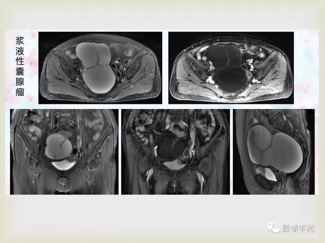 子宫卵巢病变的mri诊断
