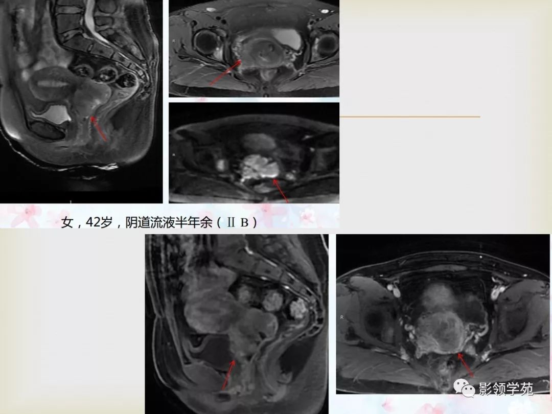 子宫卵巢病变的mri诊断