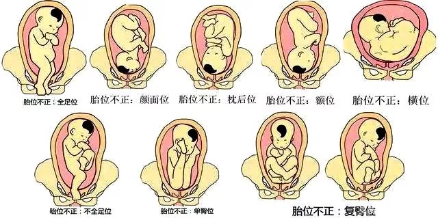 【宝宝低头出生和仰头出生有区别吗？TA的屁股比头要小，先出屁股岂不是更容易？】 