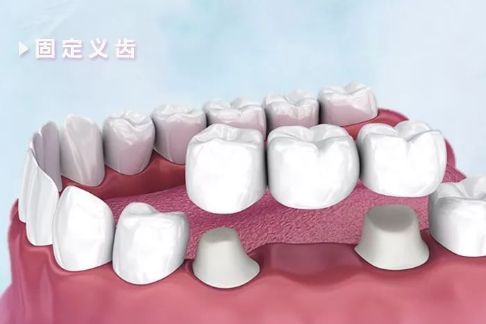 三种缺牙修复方式对比看完摆脱选择困难