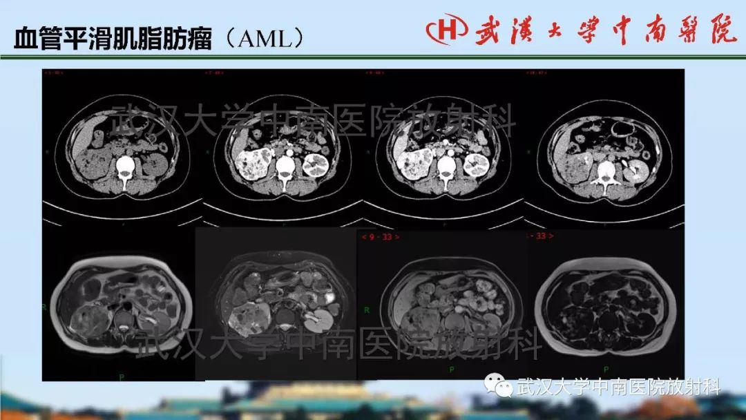 肾脏解剖与实性肿瘤的ctmri诊断梅列军