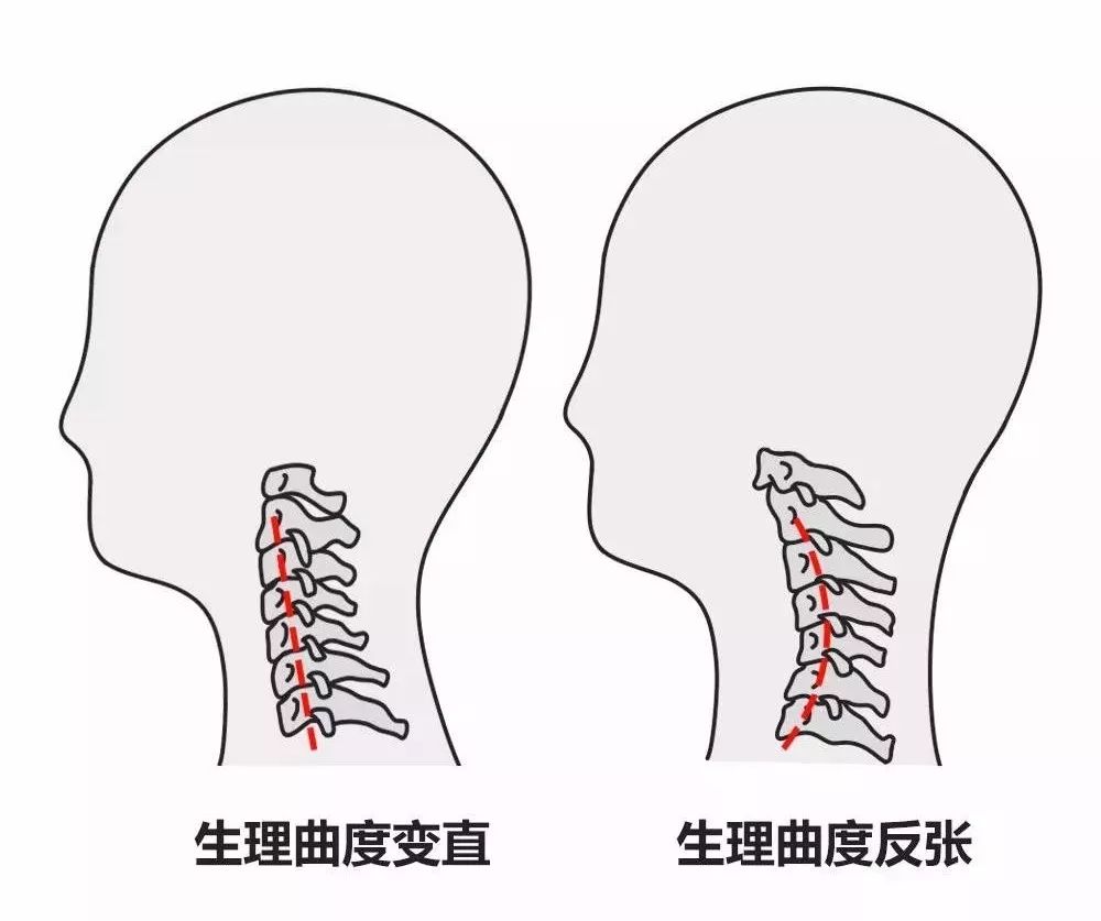 你的颈椎,用着用着就变"直"了