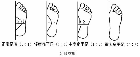 运动医学专家分析到底扁平足需不需要经常穿矫正鞋