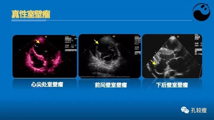 心脏介入医生应该掌握的超声心动图知识