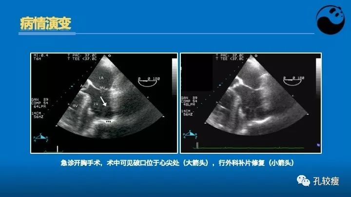 心脏介入医生应该掌握的超声心动图知识