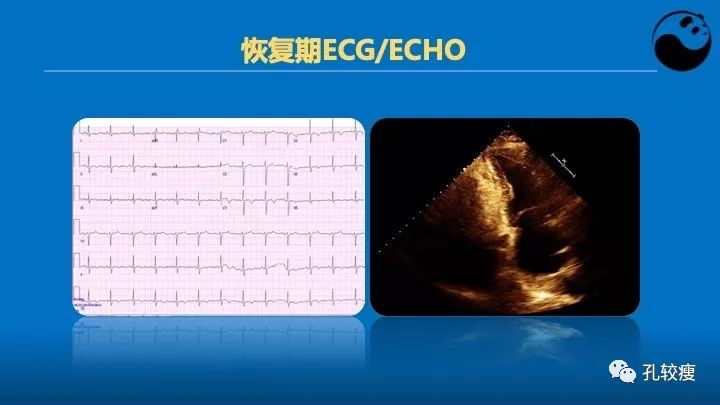 心室造影提示应激心肌病冠脉造影未见异常床旁超声提示心尖室壁瘤心电