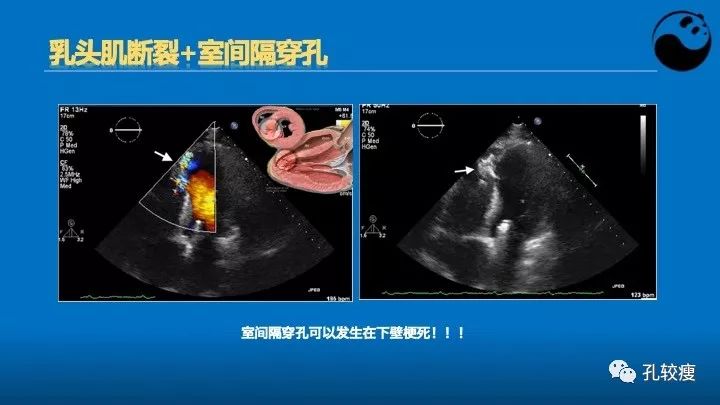 心脏介入医生应该掌握的超声心动图知识