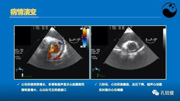 心脏介入医生应该掌握的超声心动图知识