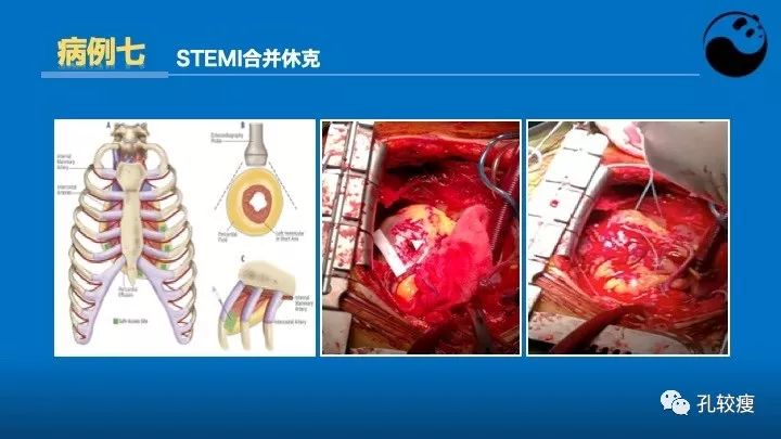 心脏介入医生应该掌握的超声心动图知识