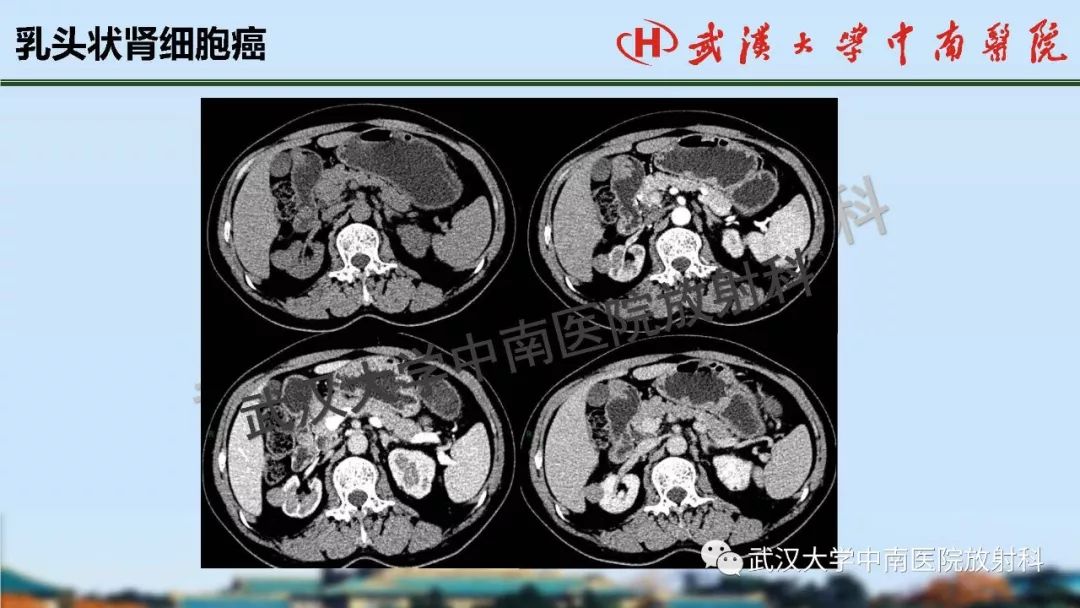 肾脏解剖与实性肿瘤的ctmri诊断梅列军