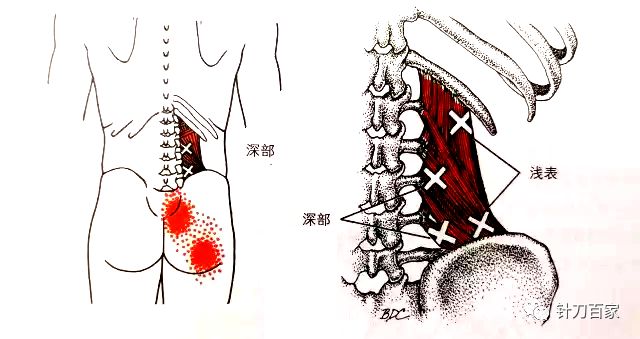 腰方肌与整体力线的关系