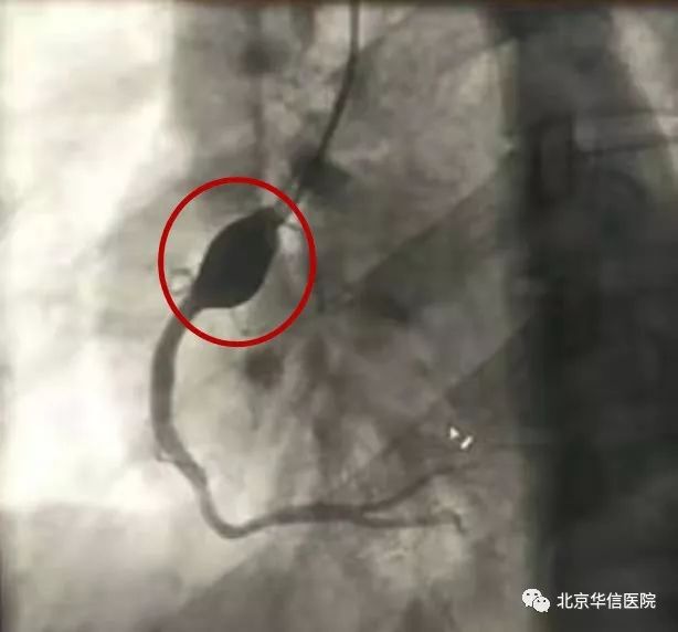 清华大学第一附属医院心脏中心外科成功救治冠状动脉瘤患者|