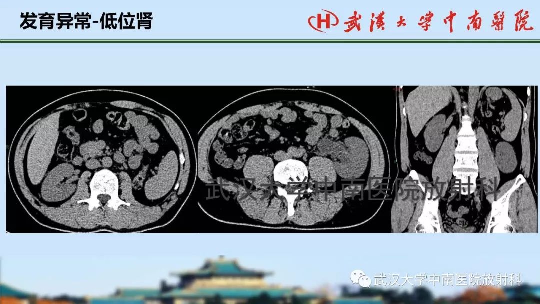 肾脏解剖与实性肿瘤的ctmri诊断梅列军