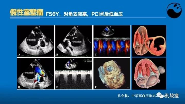 心脏介入医生应该掌握的超声心动图知识