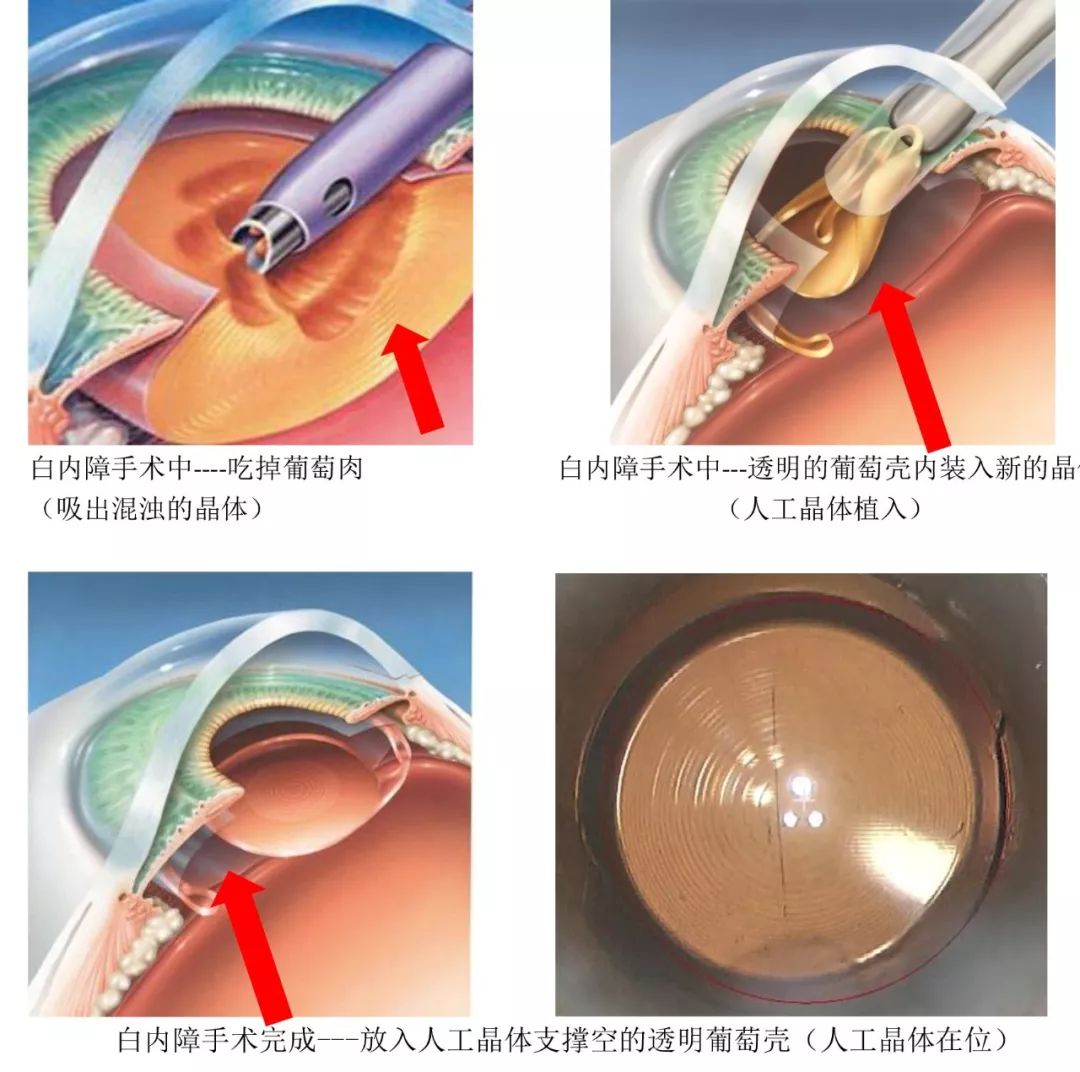 白内障手术后会复发吗