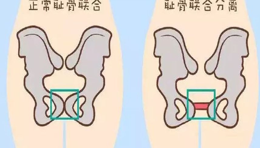 耻骨联合分离可以治疗吗?