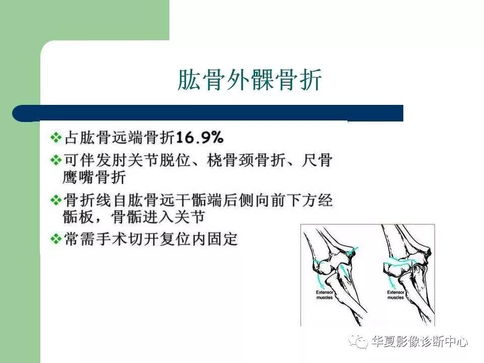 一定要注意有无关节脱位,结合患儿症状,体征,注意间接征象,是影像科