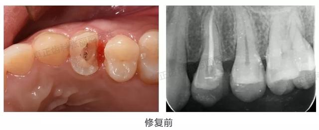 牙齿缺损了可以选择哪些修复方式