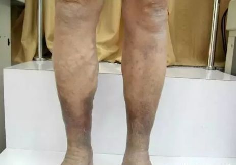 怎样防止静脉曲张严重 624a00fa5dd24639a4fc011c6d5cccdc.jpeg