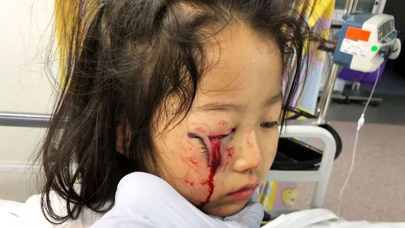(华人女童cecilia chan受伤后在医院治疗时拍摄的照片)