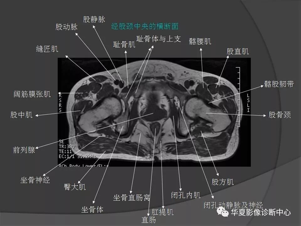 骨盆肌肉解剖mri标识