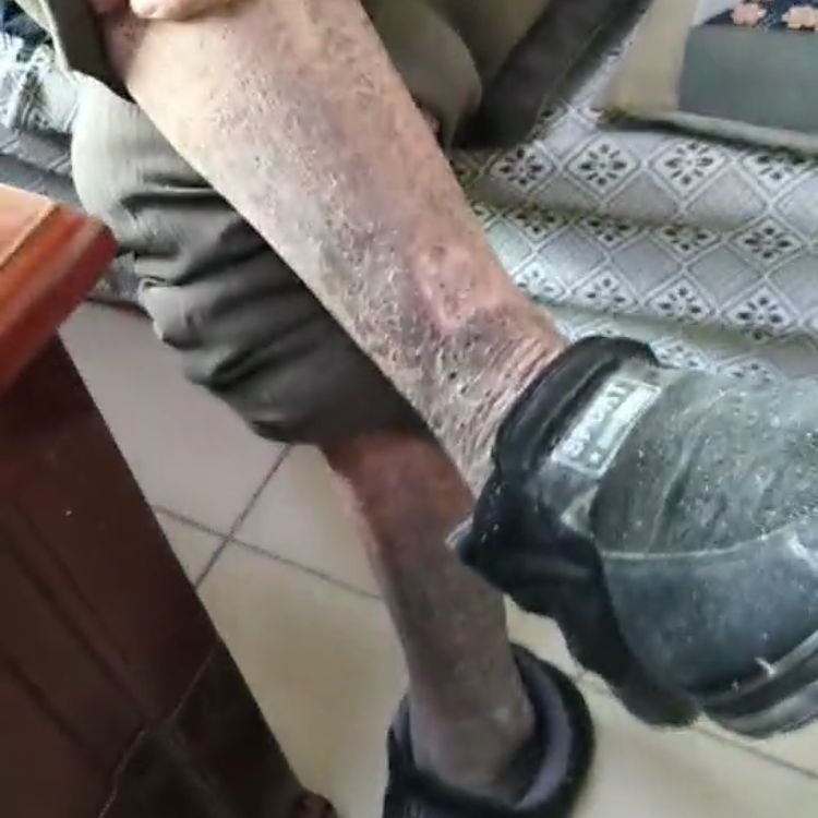 腿部皮肤发黑,于是去了医院检查,才知道自己的血糖偏高,患有糖尿病