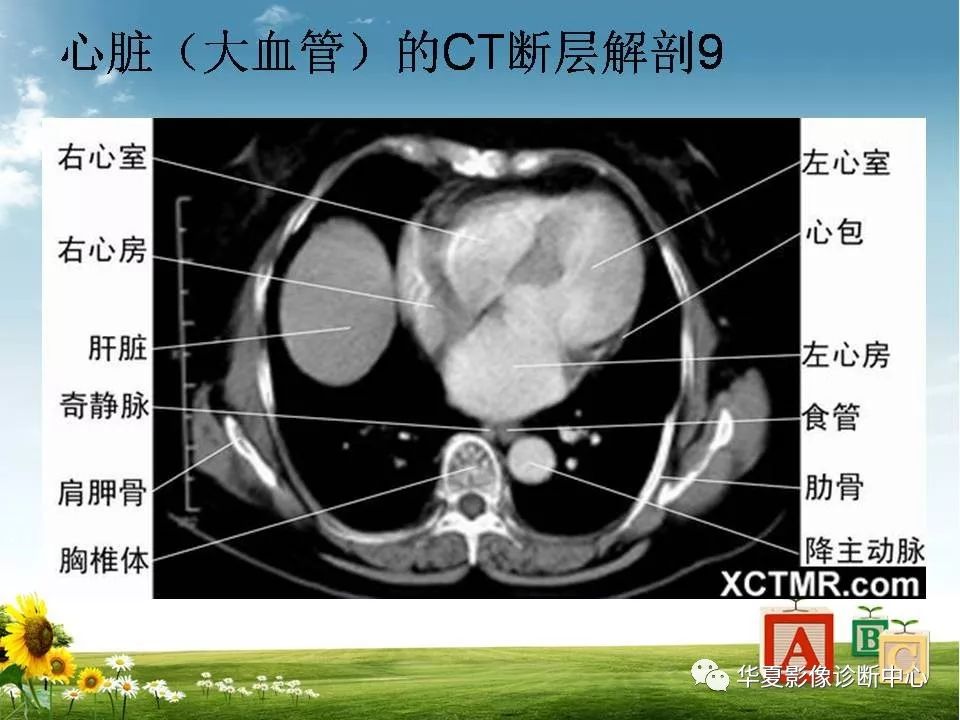 心脏大血管的影像解剖对照
