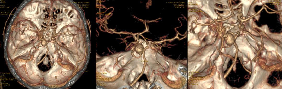 术前头颅cta