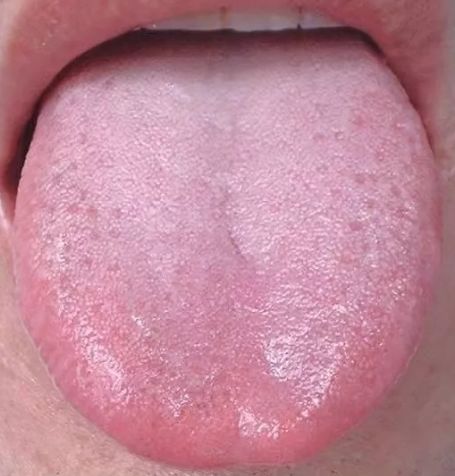 舌头中间有裂纹，或者边缘有齿痕等，是『大病征兆』？现在知道还不晚!|