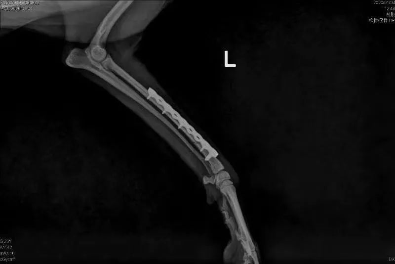 远端开放性骨折 植入物:采用protect-prcl-s5mm骨板进行内固定手术