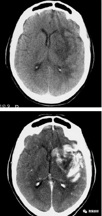 脑梗死丨演变血供区域分布ct表现