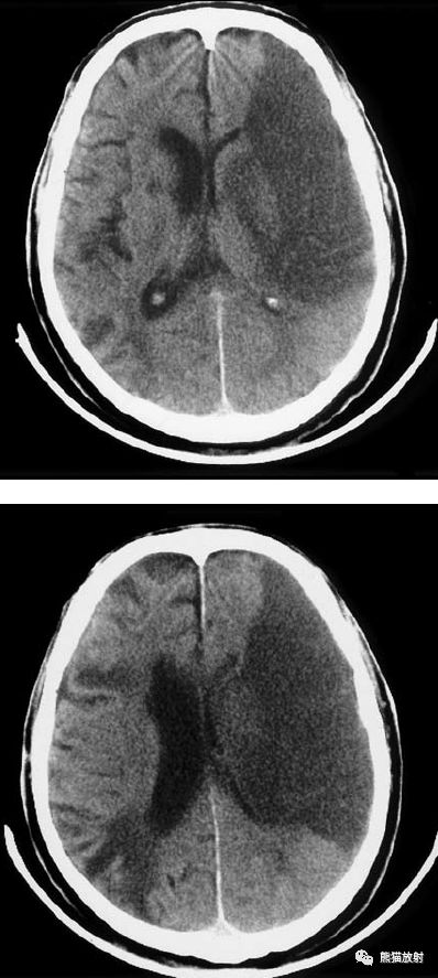 脑梗死丨演变,血供区域分布,ct表现