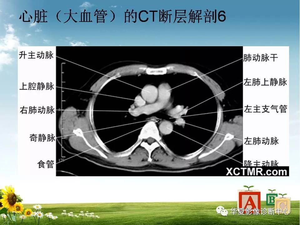 心脏大血管的影像解剖对照