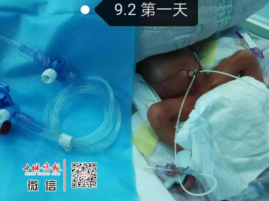 「十堰晚报」十堰妈妈怀孕6个月产下巴掌大女婴！医生拍下14张照片，张张让人落泪.....