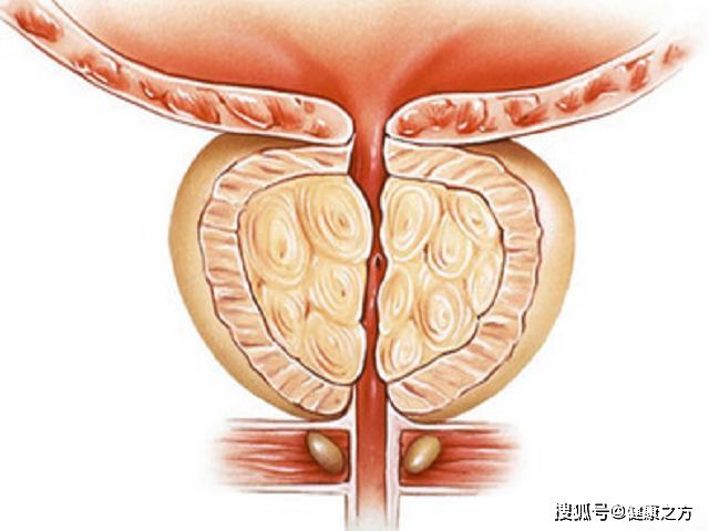 慢性前列腺炎, 早期有什么表现, 如何预防? 做好这几点预防