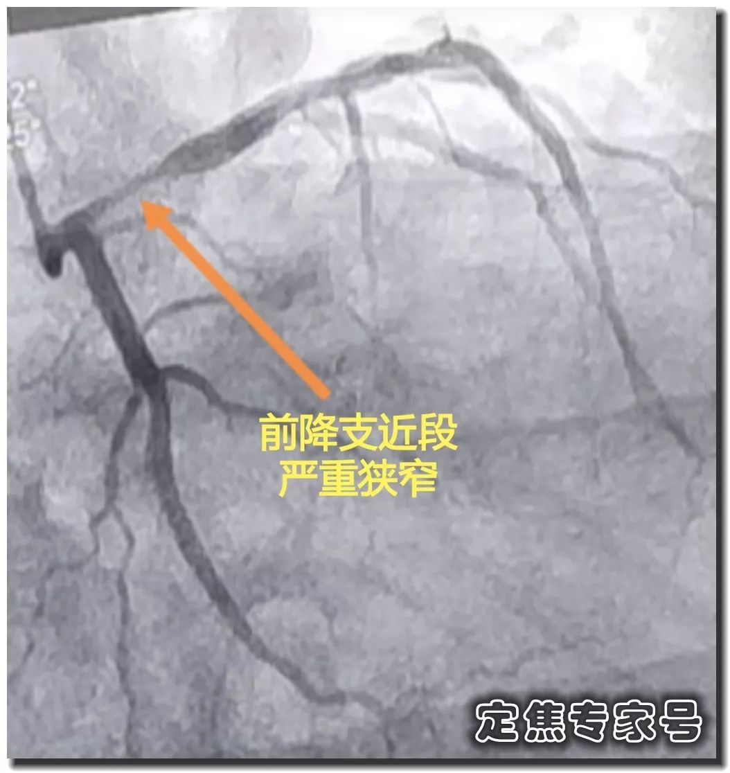 心肌大面积坏死怎么办