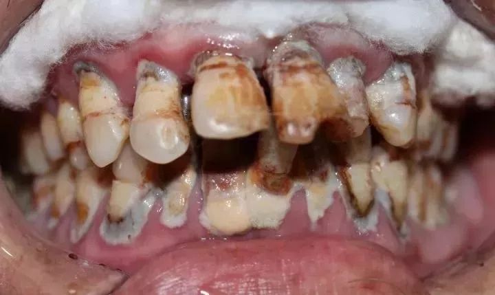 前方高能丨牙医见过最大的牙结石长什么样?