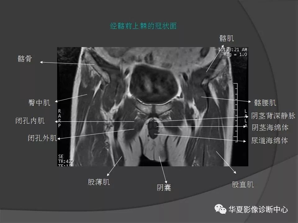 骨盆肌肉解剖mri标识