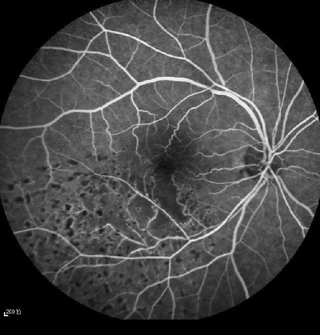 27黄斑立方扫描:中心凹下方神经视网膜变薄萎缩,厚度弥漫性下降vod:0.