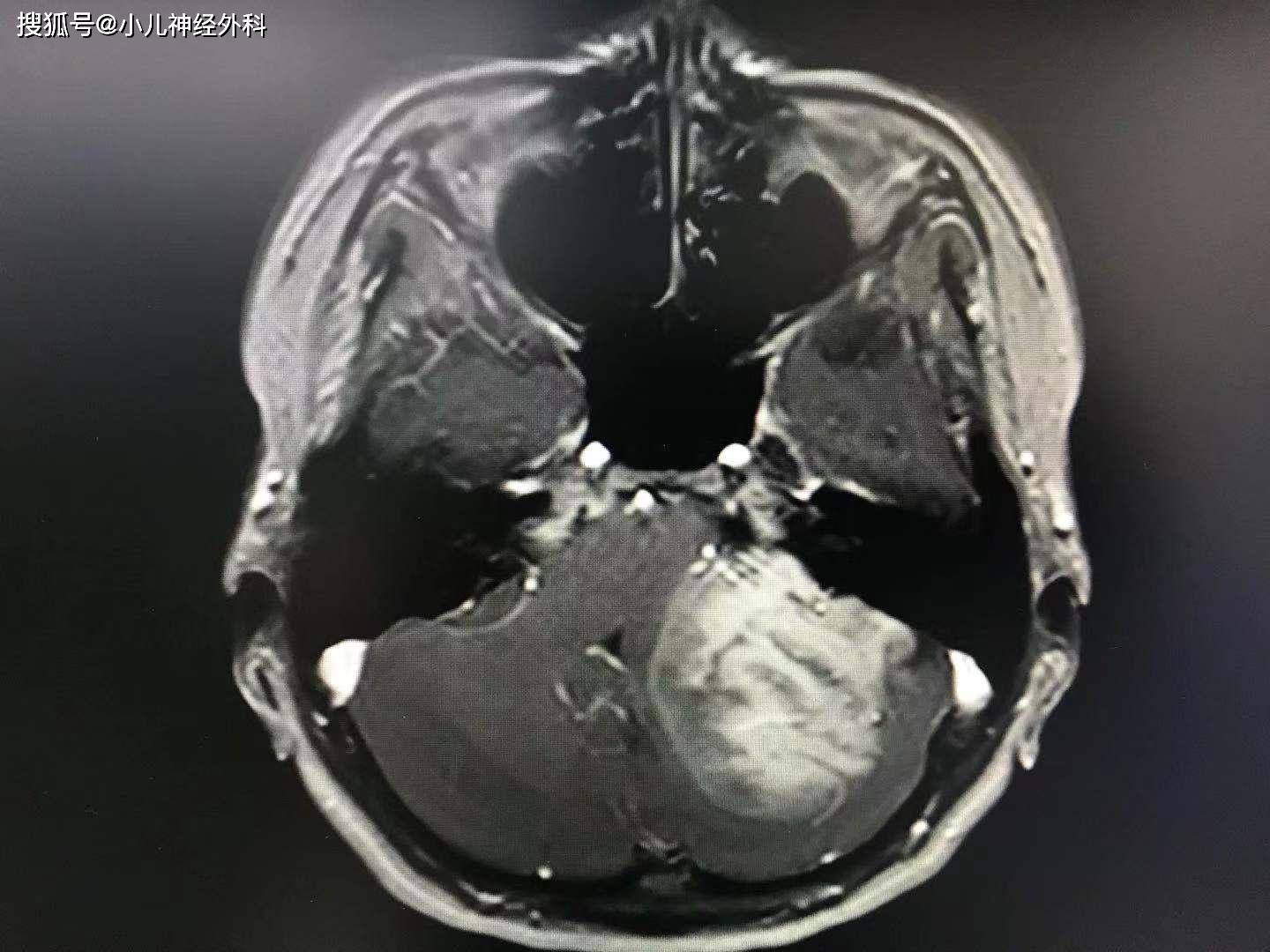 儿童脑瘤的手术全切率,提高小儿脑瘤的治愈率—一例颅内巨大肿瘤