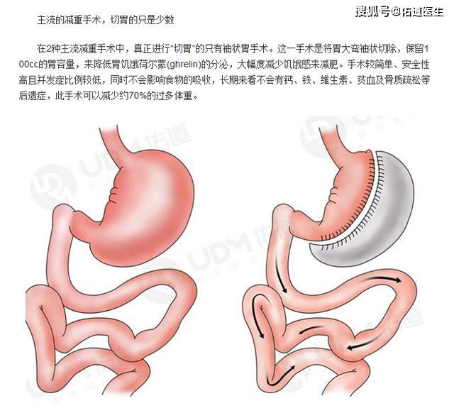 切胃减肥的效果评价