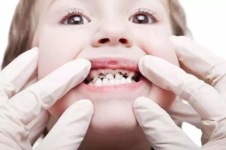 【小主编福利】孩子满嘴小黑牙,到底该怎样防蛀牙?听专家怎么说