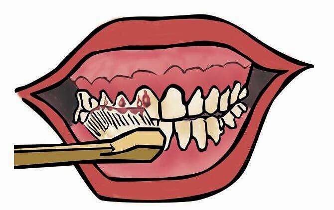  牙龈出血是因为压力过大吗？