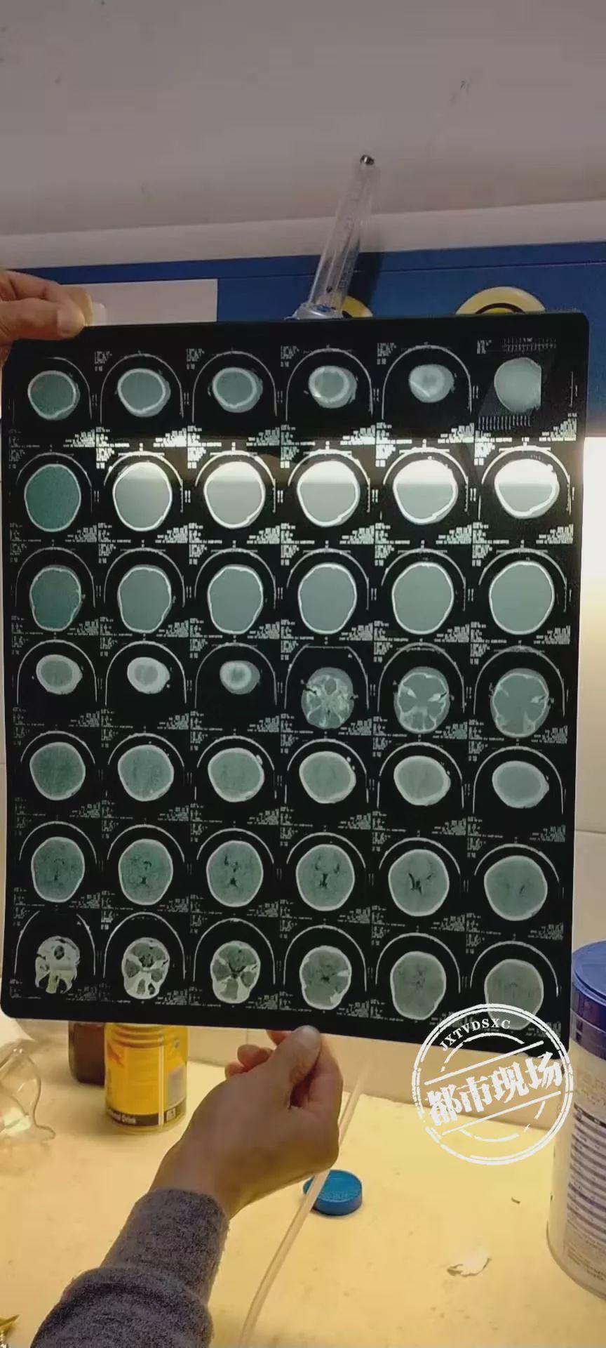 5岁女童被从天而降的躺椅砸中 头骨开裂