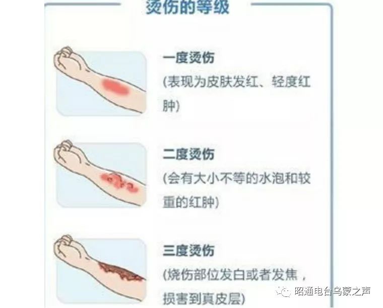 一般情况下正确的早期处理,可以减轻烧伤程度,降低并发症的发生率和