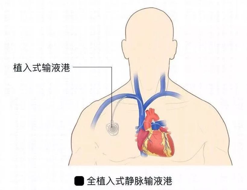 【科普展播】输液港——肿瘤患者的避风港