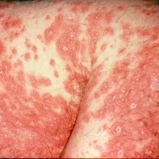 什么是生物制剂都治疗什么疾病 049240280dd640438b5efe984f04b43c.jpeg