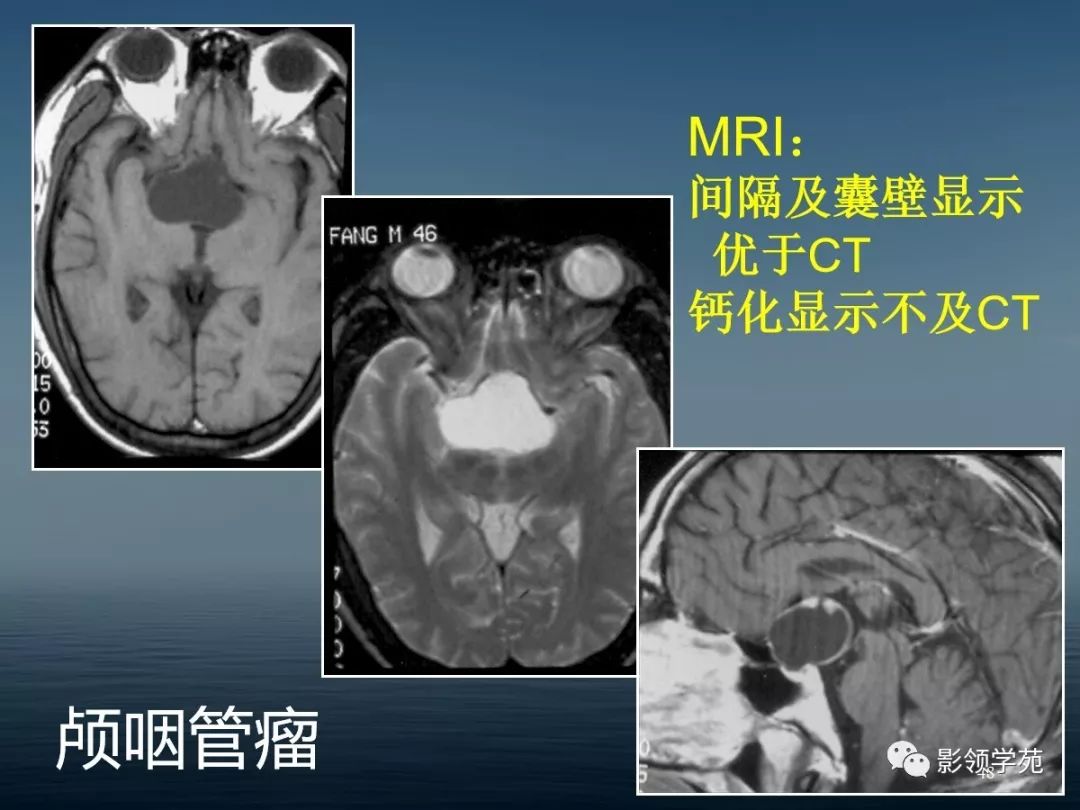 鞍区病变的ctmri诊断