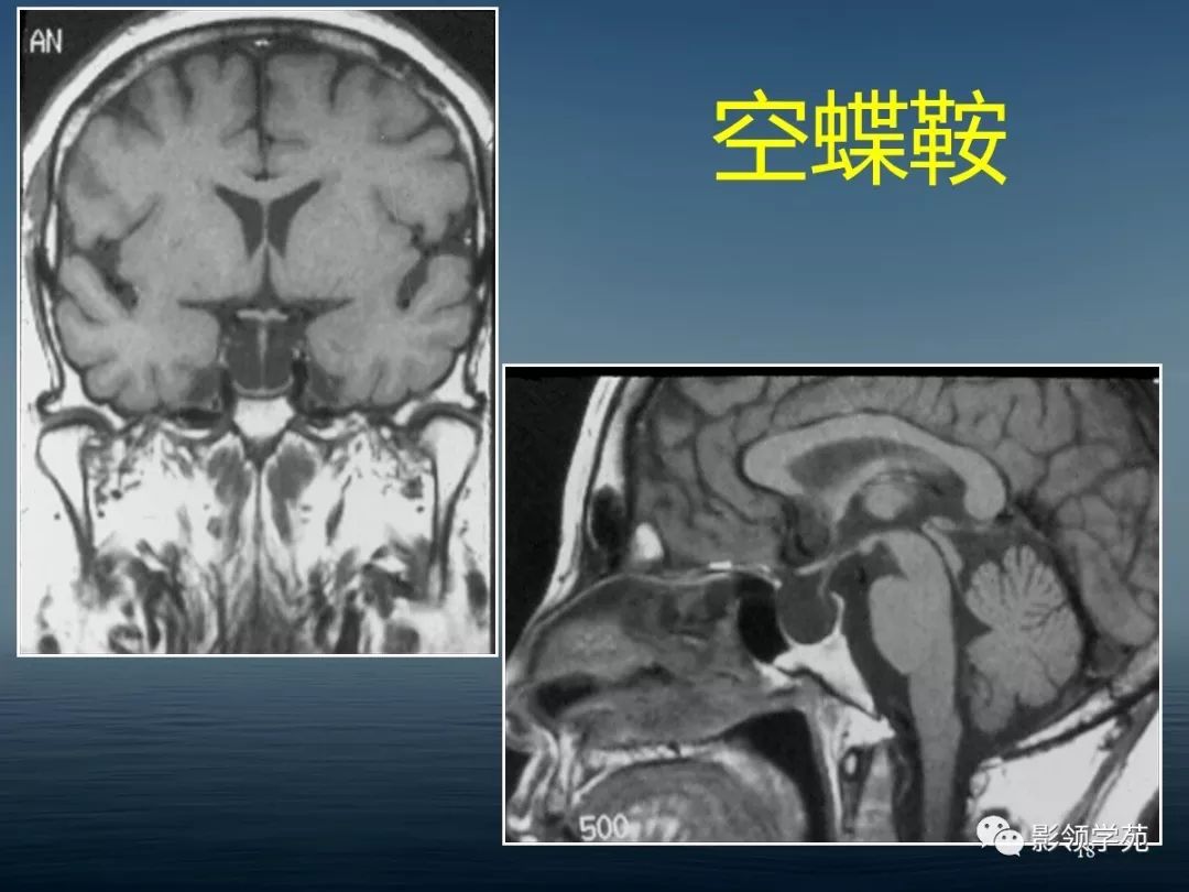 鞍区病变的ctmri诊断